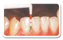 1ブラッシング状態、歯、歯肉のチェック写真